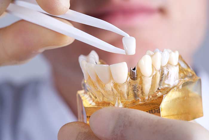 dental implants surgery houston | dental implants | Lanap Online Appointment