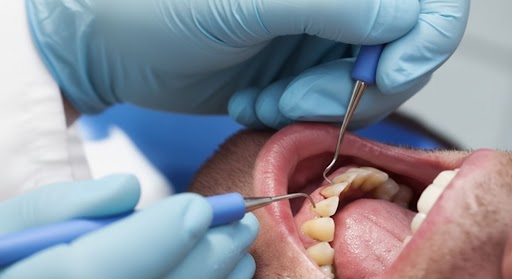 How Periodontal Surgery Saves Teeth from Gum Disease 5 Prestige Family Dentistry And Kidzone Dental