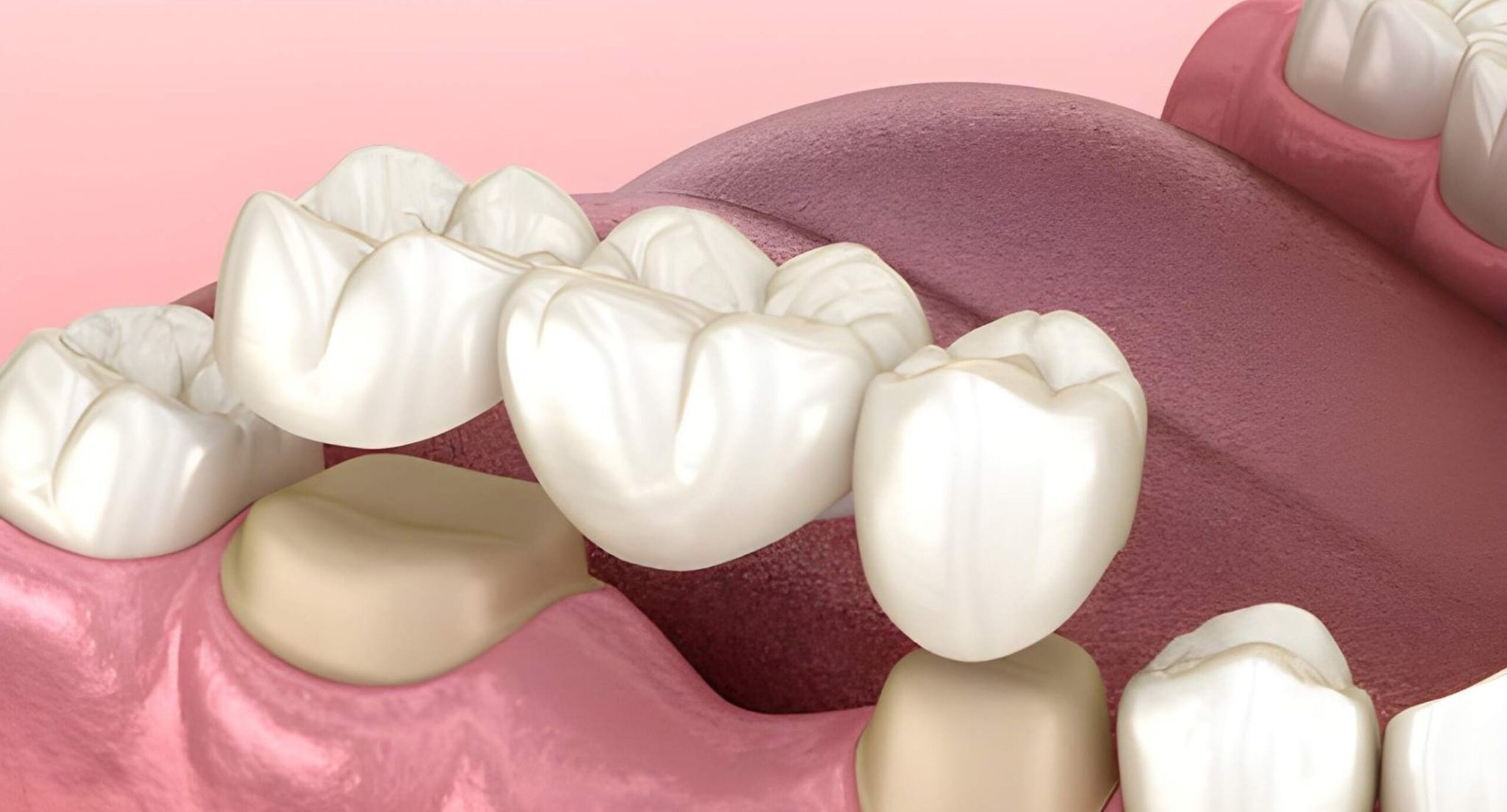 From Gaps to Confidence: How Modern Dental Bridges Are Transforming Smiles 2 Prestige Family Dentistry And Kidzone Dental