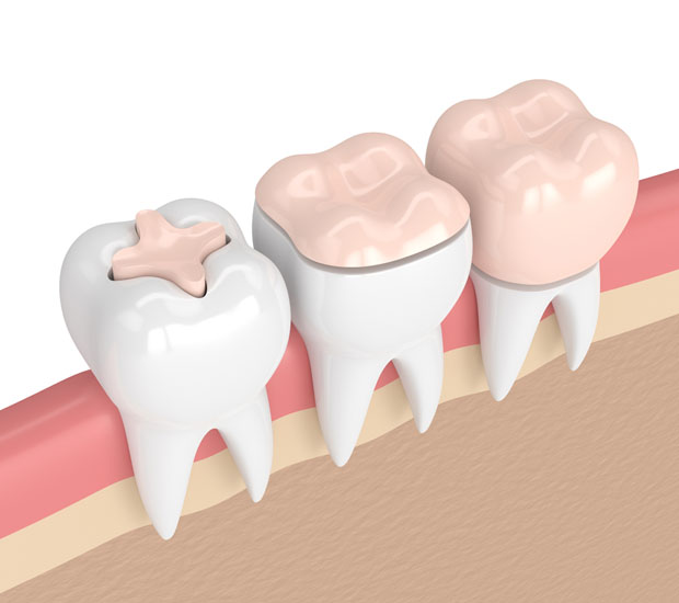 Houston Dental Inlays and Onlays