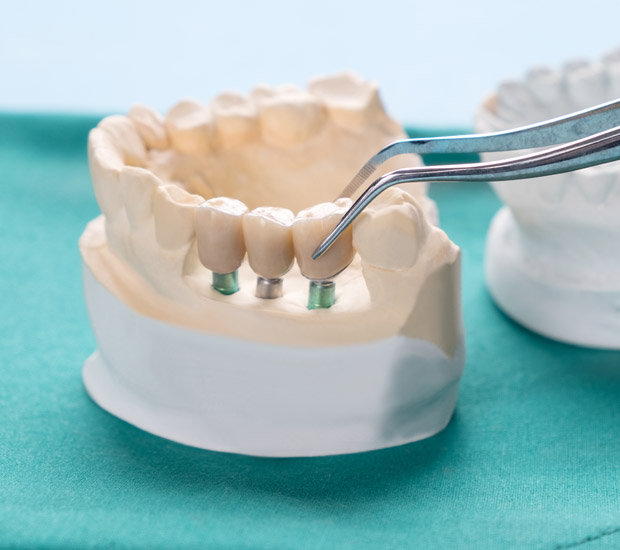 Houston Prosthodontist