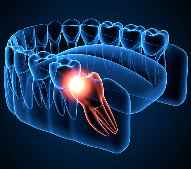 Houston Wisdom Teeth Extraction